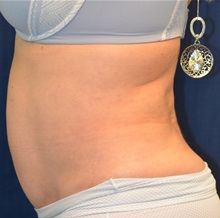 Tummy Tuck After Photo by Michael Frederick, MD; Fort Lauderdale, FL - Case 37026