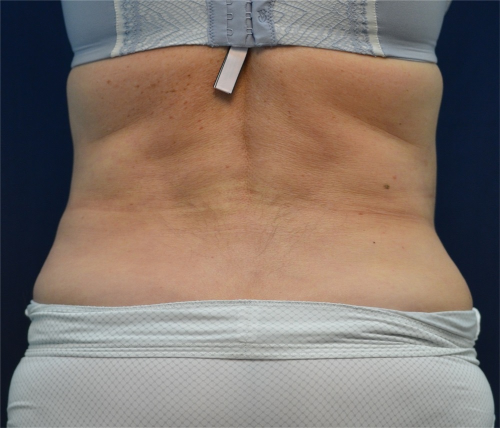 Tummy Tuck Before and After Photos by Michael Frederick, MD; Fort