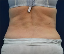 Tummy Tuck After Photo by Michael Frederick, MD; Fort Lauderdale, FL - Case 37026