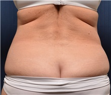 Tummy Tuck Before Photo by Michael Frederick, MD; Fort Lauderdale, FL - Case 37026