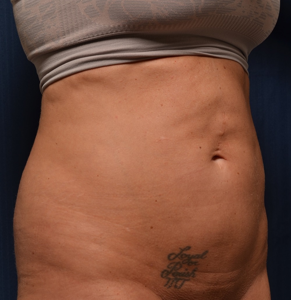 Tummy Tuck Revision  tummy tuck revision cost  Istanbul