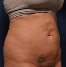 Tummy Tuck Before Photo by Michael Frederick, MD; Fort Lauderdale, FL - Case 37027