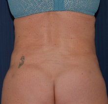 Tummy Tuck After Photo by Michael Frederick, MD; Fort Lauderdale, FL - Case 37027