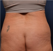 Tummy Tuck Before Photo by Michael Frederick, MD; Fort Lauderdale, FL - Case 37027