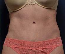 Tummy Tuck After Photo by Michael Frederick, MD; Fort Lauderdale, FL - Case 37030