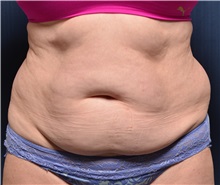 Tummy Tuck Before Photo by Michael Frederick, MD; Fort Lauderdale, FL - Case 37030