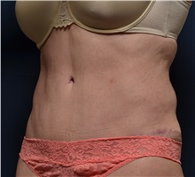 Tummy Tuck After Photo by Michael Frederick, MD; Fort Lauderdale, FL - Case 37030