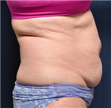 Tummy Tuck Before Photo by Michael Frederick, MD; Fort Lauderdale, FL - Case 37030