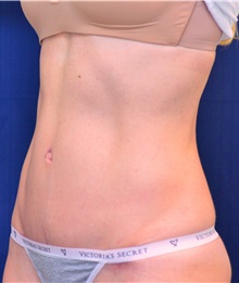 Tummy Tuck After Photo by Michael Frederick, MD; Fort Lauderdale, FL - Case 37032