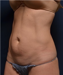 Tummy Tuck Before Photo by Michael Frederick, MD; Fort Lauderdale, FL - Case 37032