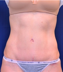 Tummy Tuck After Photo by Michael Frederick, MD; Fort Lauderdale, FL - Case 37032