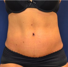 Tummy Tuck After Photo by Michael Frederick, MD; Fort Lauderdale, FL - Case 37034