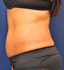 Tummy Tuck After Photo by Michael Frederick, MD; Fort Lauderdale, FL - Case 37034