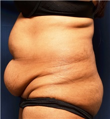 Tummy Tuck Before Photo by Michael Frederick, MD; Fort Lauderdale, FL - Case 37034