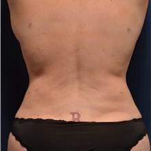 Tummy Tuck After Photo by Michael Frederick, MD; Fort Lauderdale, FL - Case 37055