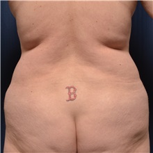 Tummy Tuck Before Photo by Michael Frederick, MD; Fort Lauderdale, FL - Case 37055