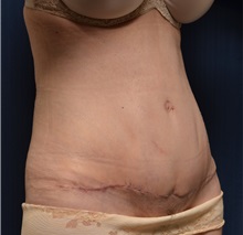 Tummy Tuck After Photo by Michael Frederick, MD; Fort Lauderdale, FL - Case 37057