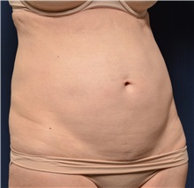 Tummy Tuck Before Photo by Michael Frederick, MD; Fort Lauderdale, FL - Case 37057