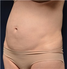 Tummy Tuck Before Photo by Michael Frederick, MD; Fort Lauderdale, FL - Case 37057