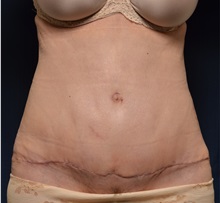 Tummy Tuck After Photo by Michael Frederick, MD; Fort Lauderdale, FL - Case 37057