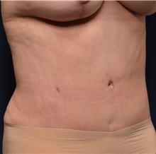 Tummy Tuck After Photo by Michael Frederick, MD; Fort Lauderdale, FL - Case 37059