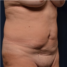 Tummy Tuck Before Photo by Michael Frederick, MD; Fort Lauderdale, FL - Case 37059