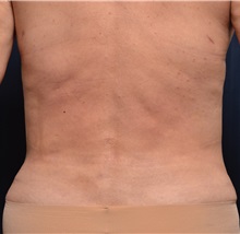 Tummy Tuck After Photo by Michael Frederick, MD; Fort Lauderdale, FL - Case 37059