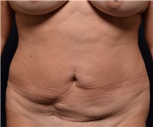 Tummy Tuck Before Photo by Michael Frederick, MD; Fort Lauderdale, FL - Case 37059