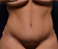 Tummy Tuck After Photo by Michael Frederick, MD; Fort Lauderdale, FL - Case 37061