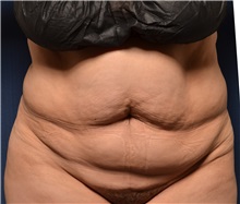 Tummy Tuck Before Photo by Michael Frederick, MD; Fort Lauderdale, FL - Case 37061