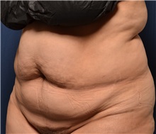 Tummy Tuck Before Photo by Michael Frederick, MD; Fort Lauderdale, FL - Case 37061