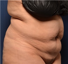 Tummy Tuck Before Photo by Michael Frederick, MD; Fort Lauderdale, FL - Case 37061