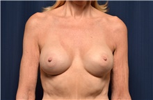 Breast Augmentation After Photo by Michael Frederick, MD; Fort Lauderdale, FL - Case 39412