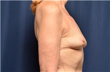 Breast Augmentation Before Photo by Michael Frederick, MD; Fort Lauderdale, FL - Case 39412