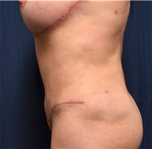 Tummy Tuck After Photo by Michael Frederick, MD; Fort Lauderdale, FL - Case 39671