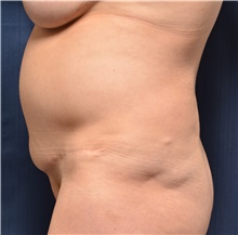 Tummy Tuck Before Photo by Michael Frederick, MD; Fort Lauderdale, FL - Case 39671