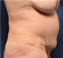 Tummy Tuck Before Photo by Michael Frederick, MD; Fort Lauderdale, FL - Case 39671