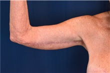 Arm Lift After Photo by Michael Frederick, MD; Fort Lauderdale, FL - Case 39712
