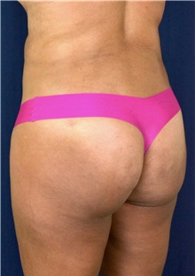 Buttock Lift with Augmentation After Photo by Michael Frederick, MD; Fort Lauderdale, FL - Case 39713
