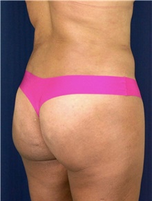 Buttock Lift with Augmentation After Photo by Michael Frederick, MD; Fort Lauderdale, FL - Case 39713