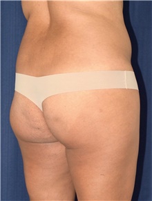 Buttock Lift with Augmentation Before Photo by Michael Frederick, MD; Fort Lauderdale, FL - Case 39713