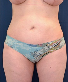 Buttock Lift with Augmentation After Photo by Michael Frederick, MD; Fort Lauderdale, FL - Case 39714