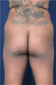 Buttock Lift with Augmentation Before Photo by Michael Frederick, MD; Fort Lauderdale, FL - Case 39716