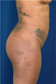 Buttock Lift with Augmentation After Photo by Michael Frederick, MD; Fort Lauderdale, FL - Case 39716