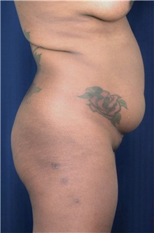 Buttock Lift with Augmentation Before Photo by Michael Frederick, MD; Fort Lauderdale, FL - Case 39716