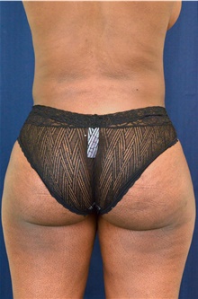 Buttock Lift with Augmentation After Photo by Michael Frederick, MD; Fort Lauderdale, FL - Case 39717