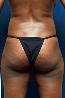 Buttock Lift with Augmentation Before Photo by Michael Frederick, MD; Fort Lauderdale, FL - Case 39717