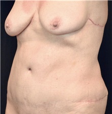 Body Contouring After Photo by Michael Frederick, MD; Fort Lauderdale, FL - Case 39718