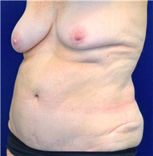 Body Contouring Before Photo by Michael Frederick, MD; Fort Lauderdale, FL - Case 39718