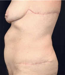 Body Contouring After Photo by Michael Frederick, MD; Fort Lauderdale, FL - Case 39718